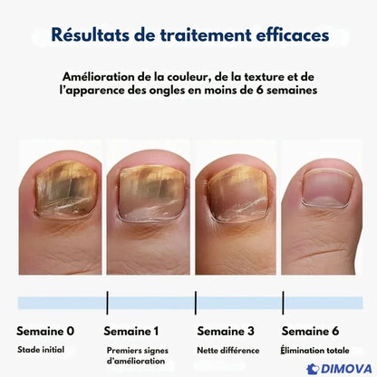 Pansements antimycosiques pour la nuit (Boîte de 60 pansements)