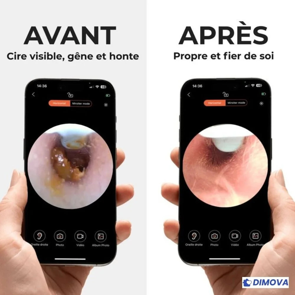 Otoscope - Nettoyeur d'oreille avec caméra intéfrée